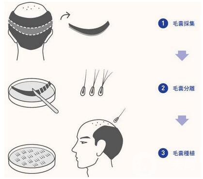 FUE毛发移植技术好吗?