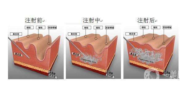 注射伊维兰除皱后应该要注意哪些问题呢?