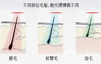 激光脱毛怎么样 激光脱毛的工作原理