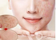 激光去晒斑多久恢复？术后如何护理呢？