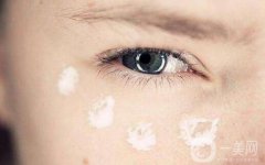 射频去眼袋贵吗 需要多少钱