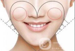 自体脂肪丰苹果肌贵吗 多少钱