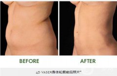 4D体轮廓吸脂术是什么?果怎么样？