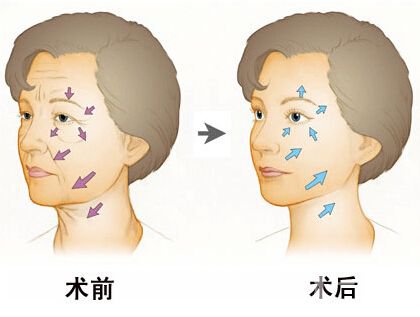 *去皱多少钱 除皱的方法有哪些