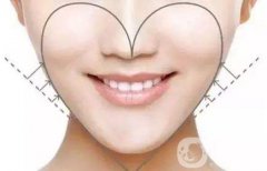 面部吸脂果图 面部吸脂注意事项