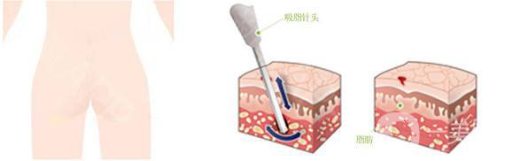 抽脂减肥价格一览表 抽脂减肥有危害吗