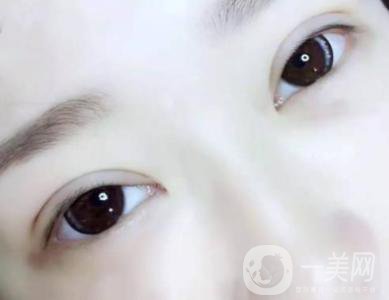 北京双眼皮手术价格 双眼皮手术多久消肿