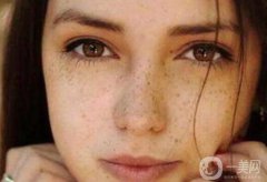 激光祛斑果怎么样？有哪些优势？