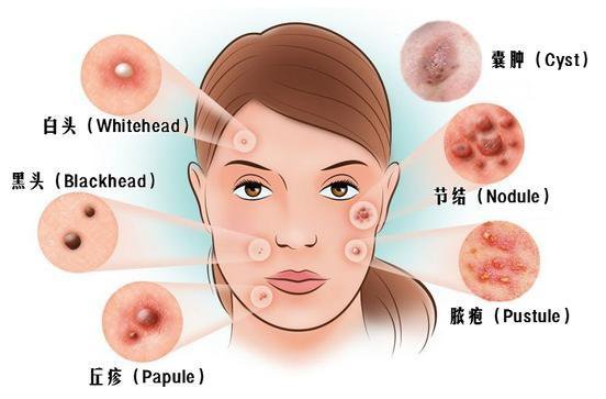 痤疮调节的*佳方法是什么呢?