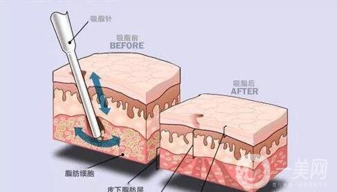 镭射溶脂怎么样 镭射溶脂的功*是什么