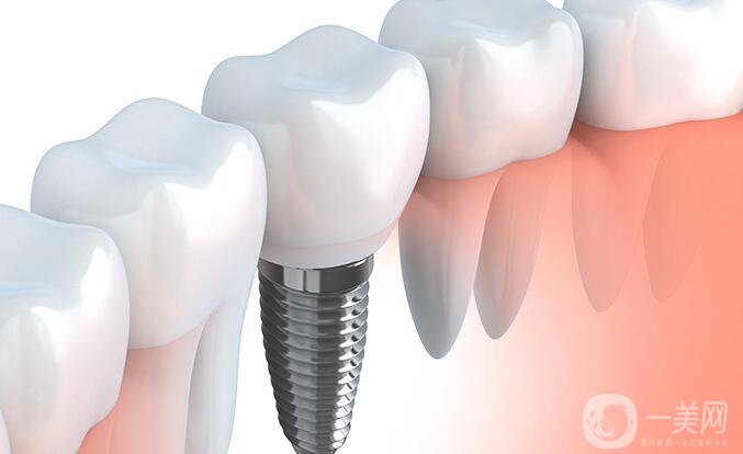种植牙和镶牙哪个更好