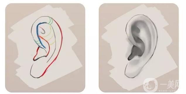 耳廓成形术要多久时间恢复 耳廓成形术风险大吗