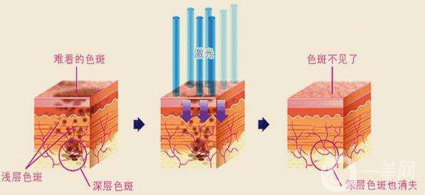 激光祛斑的价格 激光祛斑的*果好不好