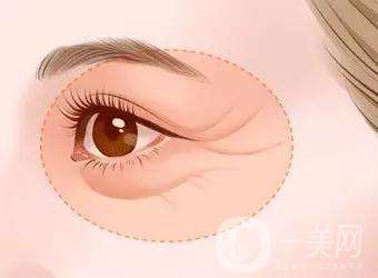 眼部除皱手术方法有哪些 眼部除皱有副作用吗