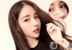 歪鼻矫正手术是怎样的 手术方法有哪些？