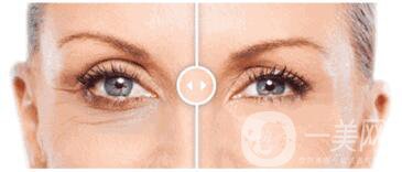 造成下眼皮松弛的原因 下眼皮松弛需要做手术吗