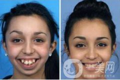 天包地矫正前后图片：颜值变化不止一点点