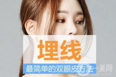 埋线双眼皮果图：不是人人都适合做埋线双眼皮