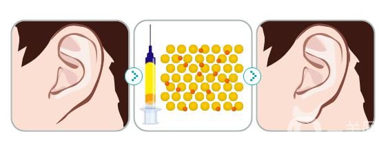 注射玻尿酸丰耳垂前后 丰耳垂*果好不好？