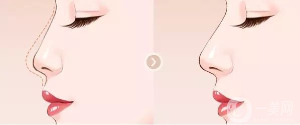 鼻成形术是什么 鼻成形术的作用是什么