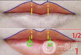 厚唇改薄手术注意事项
