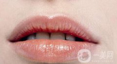 玻尿酸丰唇多久消肿?注意事项有哪些？