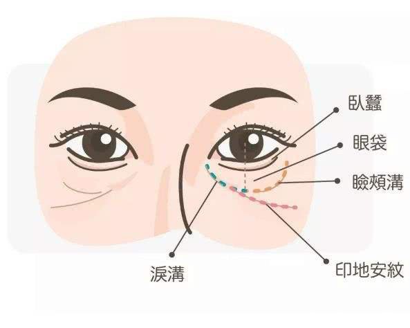 泪勾填充多少钱呢 哪些因素影响泪沟价格