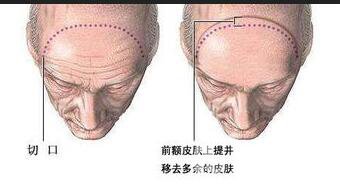 去除抬头纹风险,去除抬头纹方法