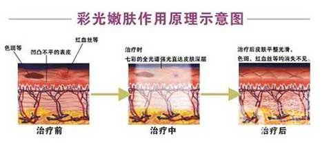 彩光嫩肤好吗？*果如何？