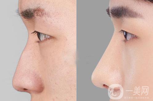 什么是鼻尖手术 鼻尖手术的特点
