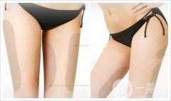 大腿抽脂需要多久恢复正常呢