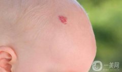 胎记的类型及去胎记方法介绍