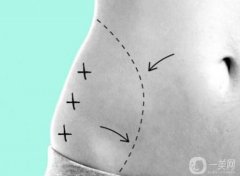 360度环形吸脂10斤照片曝光，果虽好……