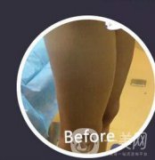 腿部环形抽脂果如何？小粗腿到筷子腿就这么简单