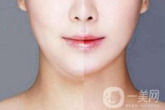 下巴抽脂有什么风险？医生说副作用有这些
