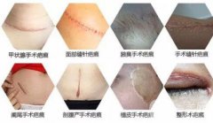 怎样修复手术疤痕？祛疤方法有哪些？