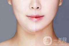 双下巴抽脂多久恢复？双下巴抽脂七天后能相亲吗