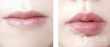 唇填充剂指南：比较不同类型的唇部注射