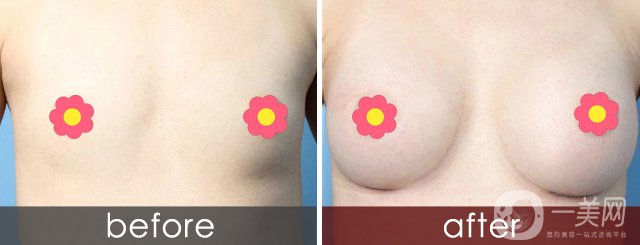 做隆胸手术疤痕 隆胸腋下瘢痕怎么去除?