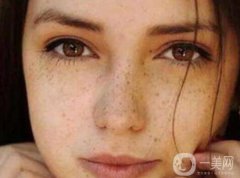激光祛斑副作用大吗？值不值得做
