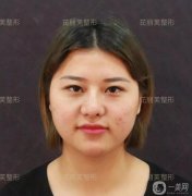 面部光纤溶脂一年后，我来说说这一年来的体会