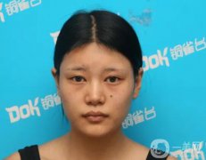 自体脂肪填充脸真人案例：路人到仙女的蜕变