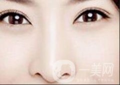 驼峰鼻整容：关于矫正驼峰鼻的方法和注意事项