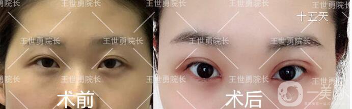 北京双眼皮修复