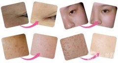 光子嫩肤后注意事项有哪些 多久做一次呢