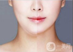 面部吸脂恢复多久？面罩戴多久？