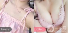 自体脂肪隆胸术前术后注意事项