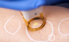 光电美容项目有哪些呢？光电美容简单介绍