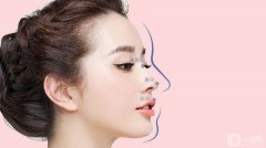 成都鼻翼缩小费用是多少呢 看成都专家怎么解析