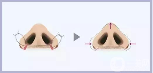 成都鼻翼缩小费用是多少呢